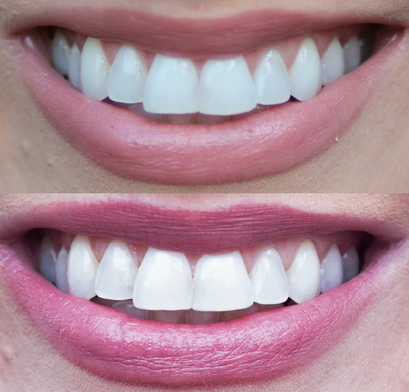 Easy Custom Teeth Whitening for Busy Professionals